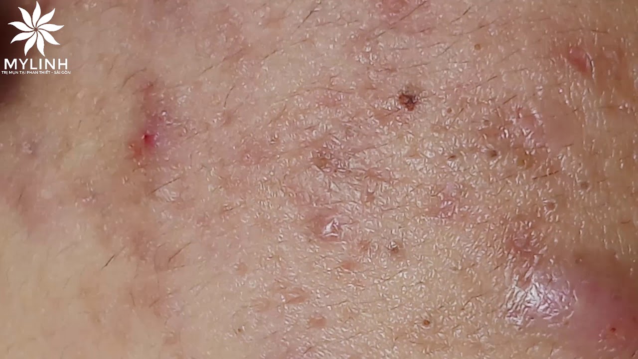 BLACKHEADS AND ACNE REMOVAL #20 | Nặn mụn ẩn dưới da, mụn đầu đen | 黑頭和粉刺去除 | 0934000075