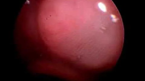 Sleep Endoscopy - Paul Hoff, MD  Ann Arbor  USA