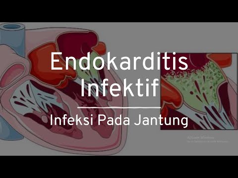 Video: Di manakah endokarditis ditemui dalam badan?