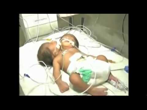 Vidéo: Un Bébé à Deux Têtes Est Né En Inde - Vue Alternative