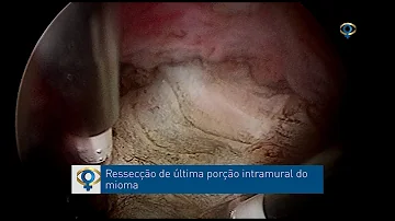 Como é realizado o exame de histeroscopia diagnóstica?