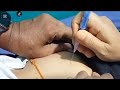 Girl get Intramuscular injection💉 in buttock💉 safe and painless technique #iminjection #injection