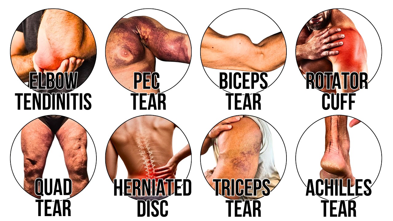 Every Lifting Injury Explained in 8 Minutes