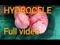 Hydrocele - पूरा ऑपरेशन का विडियो