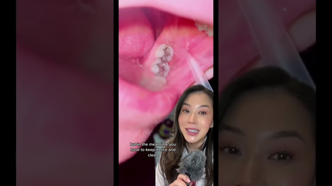 Keeping Wisdom Teeth Clean Wisdomteeth Wisdomtooth Whattoeatafterwisdomteeth Dentalvideo