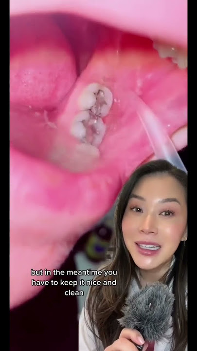 Keeping wisdom teeth clean. #wisdomteeth #wisdomtooth #whattoeatafterwisdomteeth #dentalvideo