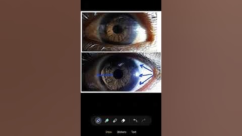 Torch light evaluation for anterior chamber depth