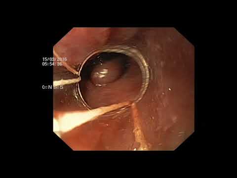 Эндоскопическое лигирование варикозно расширенных вен пищевода