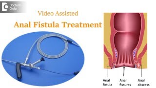 What Is Video Assisted Anal Fistula Treatment Vaaft? - Dr. Rajasekhar M R