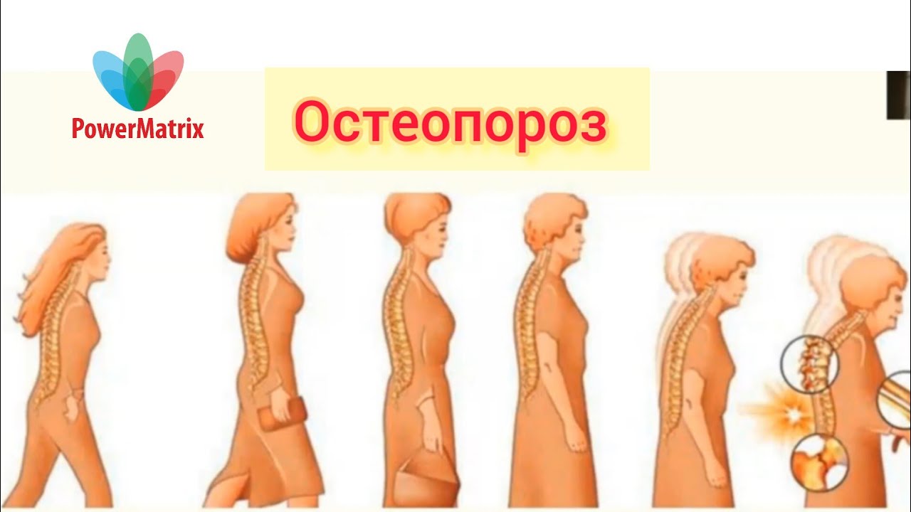 Почему с возрастом снижается. Сенильный остеопороз. Остеопороз изменения кости с возрастом. Остеопороз искривление позвоночника.