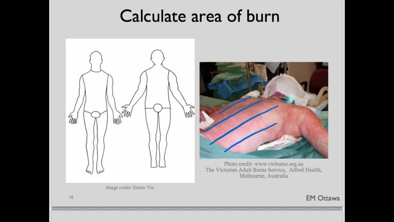 Ems Burn Chart