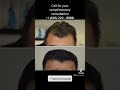 Best Before and After FUE Hair Transplant in LA, Los Angeles, Beverly Hills, San Francisco.