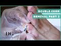 Corn Removal with callus - Double corn Part 2 (Left Foot)
