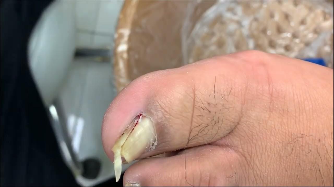 Extremely curve and ingrown toenail treatment and cutting He Pedicure