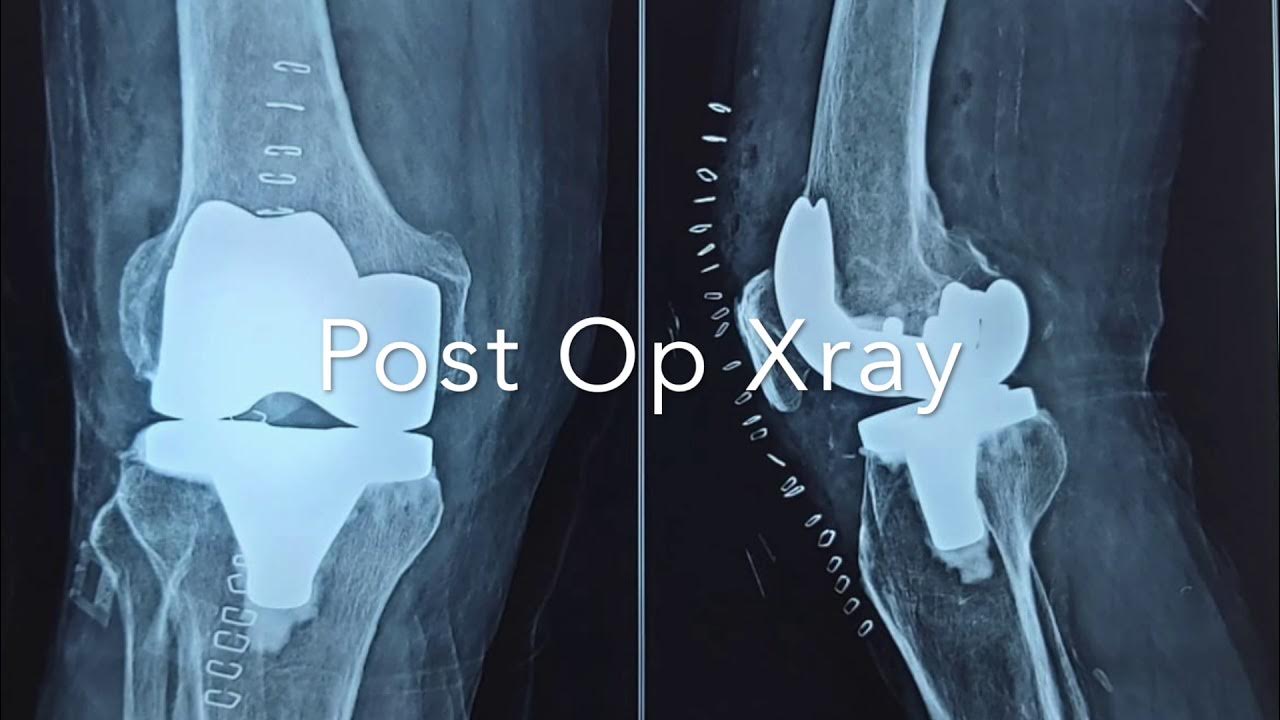 Painfree Faster Recovery with Fast Track Knee Replacement YouTube
