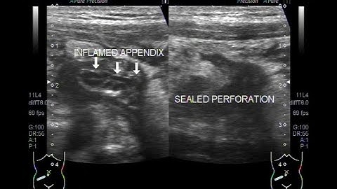 Inflamed Appendix with Sealed perforation and enlarge Lymph nodes.