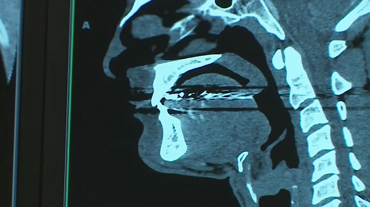 What Causes Ice Cream Headaches?