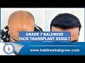 Best Hair Transplant In Hairfree & Hairgrow Clinic || Grade 7 Baldness || Hair Transplant By Doctor