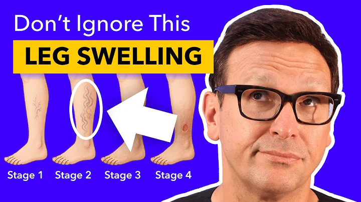 All You Need To Learn About Venous Insufficiency From A CardioVascular Surgeon