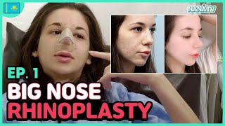 [12-1] My Bulbous tip Nose Job Rhinoplasty in Korea vlog  | experience, before and after, recovery