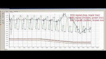 Ppg Ecg/ekg signal feature extraction