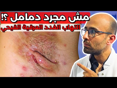 التهاب الغدد العرقية القيحي الدمامل تحت الابط قصة استاذ كامل اللي عنده دمامل