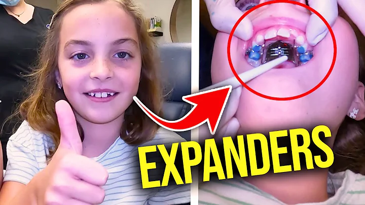 Getting a Palatal Expander....How expanders work | McKinney Orthodontist