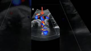 Umbilical cord around fetus neck  Ultrasound short video