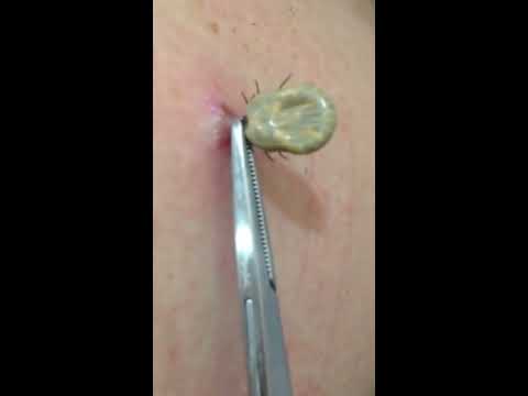 Tick removal by US doctor