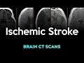 Ischemic stroke brain ct scans