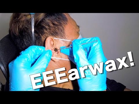 Big Earwax Removed From Man's Ear Using Ear Curette