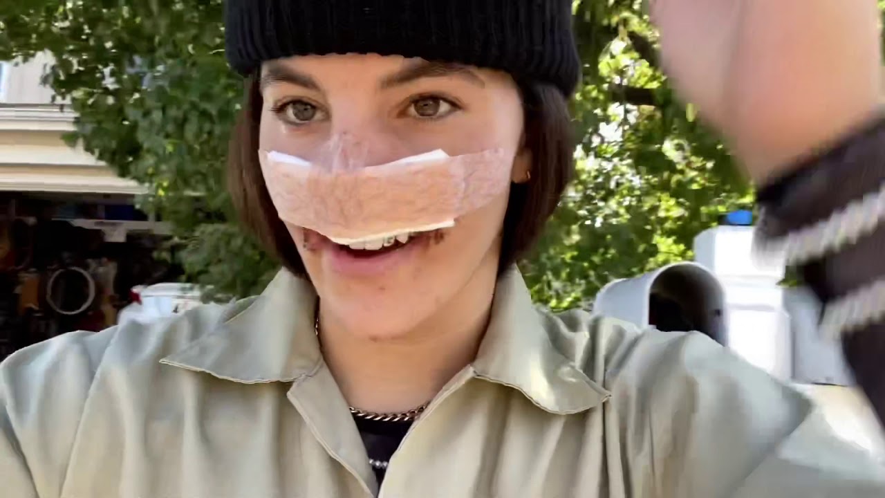week 3 how i m feeling 3 weeks after a dog ripped off my face youtube