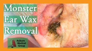 Monster Ear Wax Removal Brings New Life to JOKESTER Patient! | Auburn Medical Group Resimi