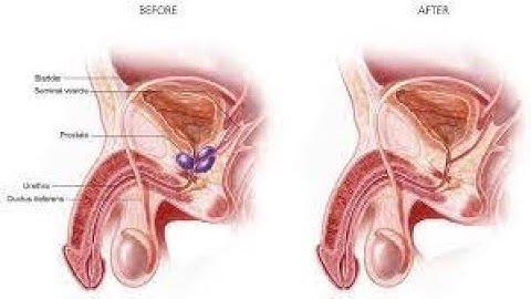 CPT code for Prostatectomy - simplify medical coding