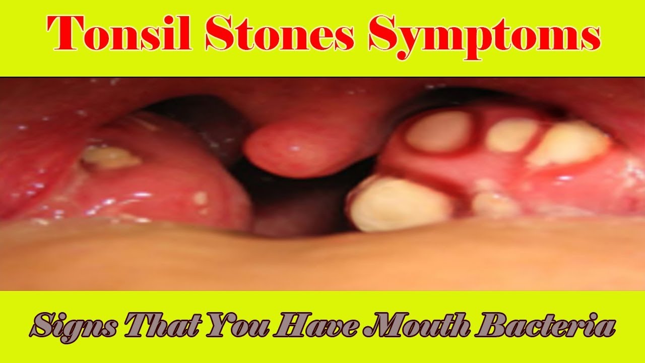 Tonsil Stones Symptoms Signs That You Have Mouth Bacteria Infection
