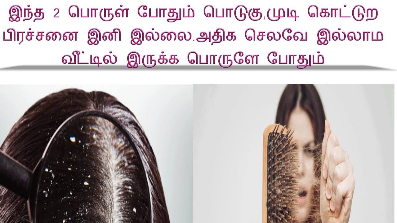 How to cure dandruff and hair loss/பொடுகு மற்றும் முடி கொட்டுற பிரச்சனை இனி இல்லை 100 guarentee