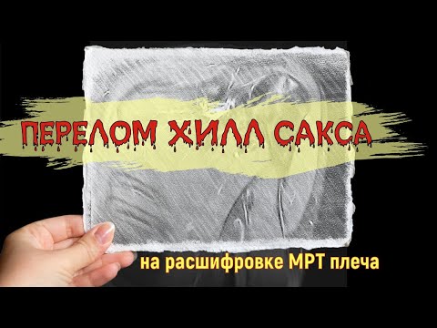 Субакромиальный ИМПИНДЖМЕНТ СИНДРОМ и ПЕРЕЛОМ Хилл Сакса на РАСШИФРОВКЕ МРТ плечевого сустава