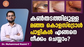 കൺതടത്തിലുള്ള മഞ്ഞ കൊളസ്ട്രോൾ പാളികൾ എങ്ങനെ നീക്കം ചെയ്യാം? | xanthelasma Malayalam | Razmi Derma