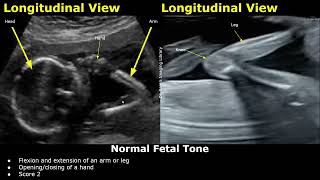 Fetal Biophysical Profile Ultrasound Normal Vs Abnormal Values | Fetus Breathing/Tone BPS/BPP USG