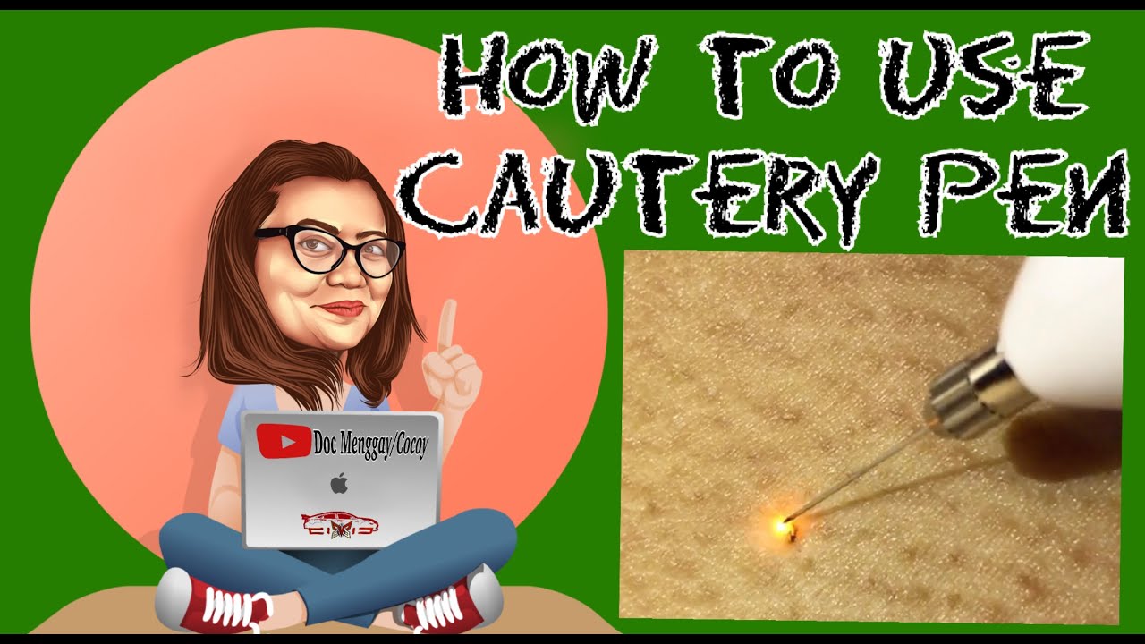 How to use Cautery Pen (mole and wart removal pen) #docmenggay - YouTube