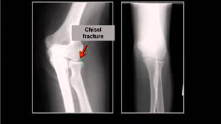 LearningRadiology 56  Forearm Fracture Disclocations    YouTube