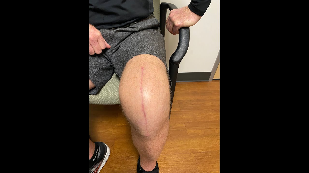 Post operative Knee Replacement Wound Care