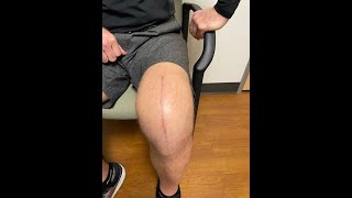 Post operative Knee Replacement Wound Care