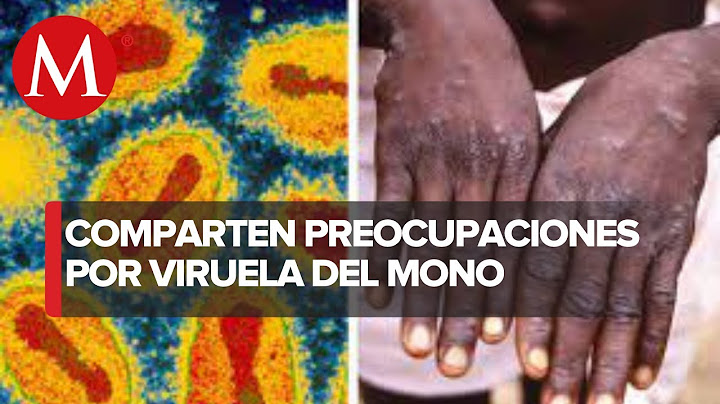 Por el momento, viruela del mono no es una emergencia sanitaria internacional: OMS