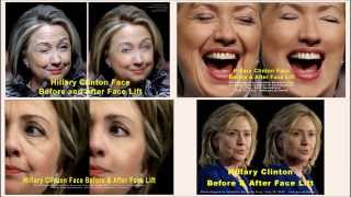 Hillary Clinton Face Before and After Face Lift #448 np