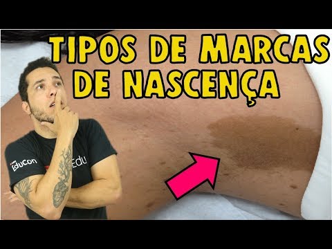 Vídeo: De onde você tira marcas de nascença?