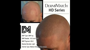 Scalp Micropigmentation SMP done in Scottsdale Arizona Plus Zero Shine