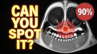 Why You're Getting Sinusitis Wrong on Board Exams