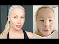 I had Facial Feminisation Surgery (One year update)