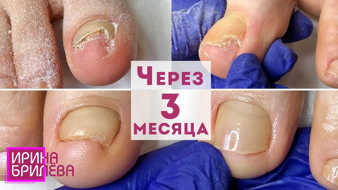 Будет ХОРОШИЙ РЕЗУЛЬТАТ, если правильно ухаживать за ногтями 🌸 ПЕДИКЮР 🌸 Ирина Брилёва